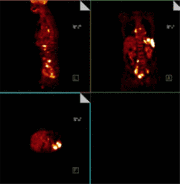 Lymphom