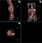 Lymphom